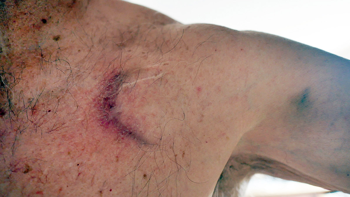 pacemaker bruise