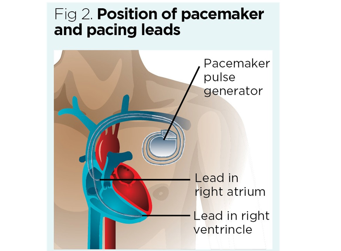 pacemaker