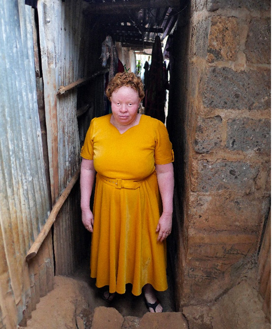 amani-albinism-kibera-2